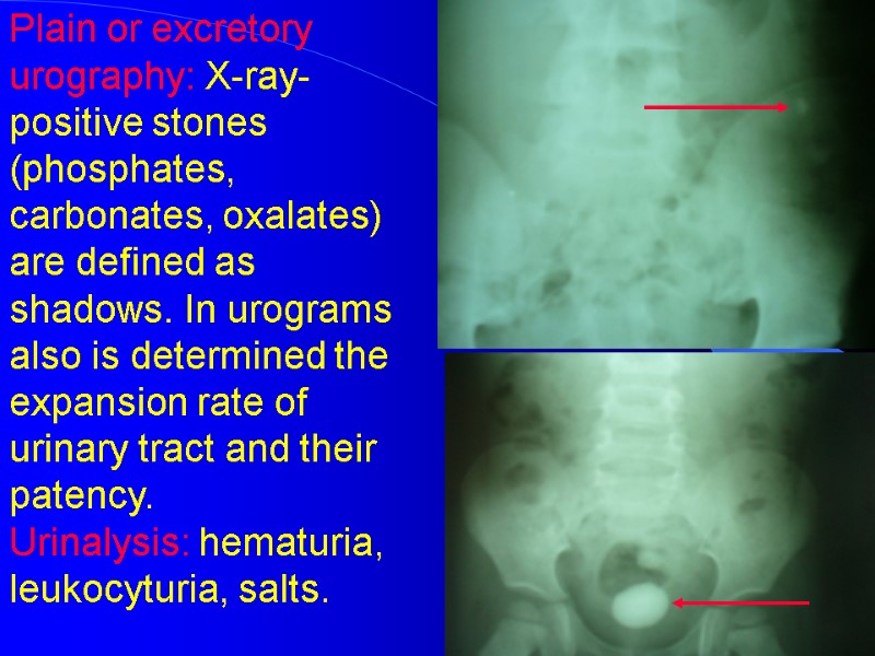 Plain or excretory urography: X-ray-positive stones (phosphates, carbonates, oxalates) are defined as shadows. In Plain or excretory urography: X-ray-positive stones (phosphates, carbonates, oxalates) are defined as shadows. In
